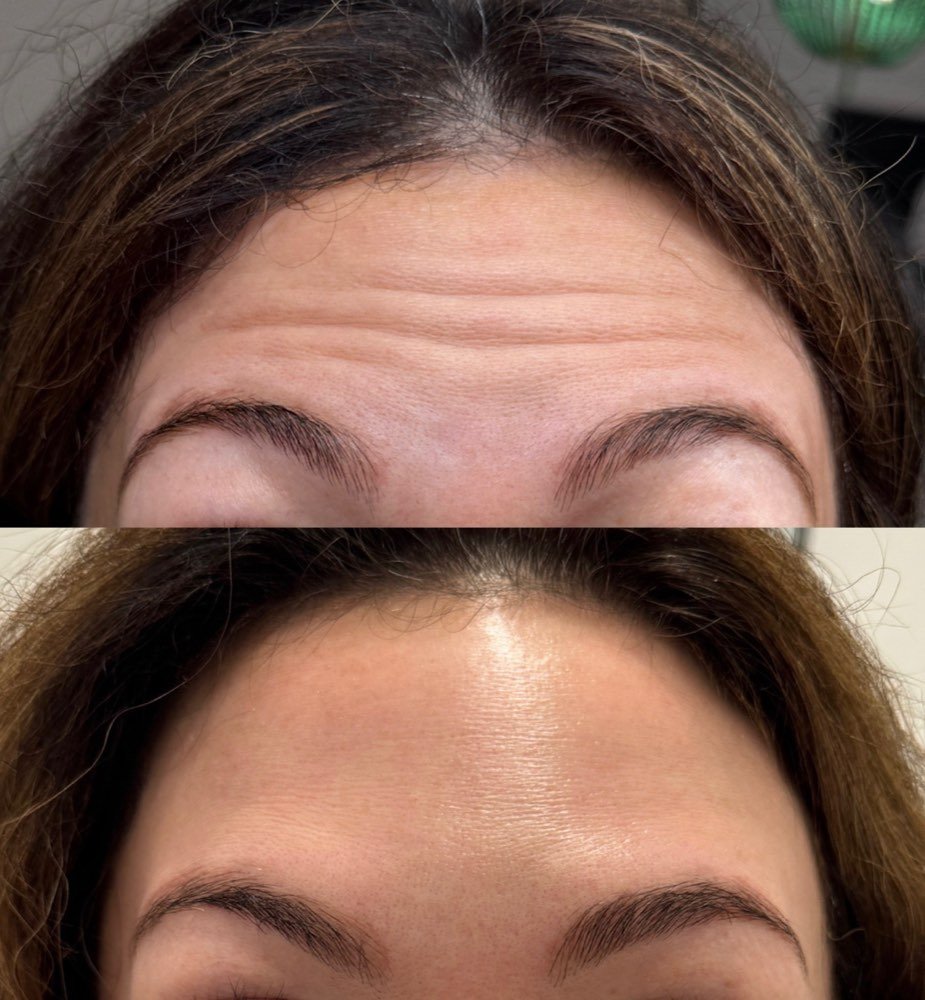 Botox before and after at Temple Collective Medspa in Springfield, Illinois